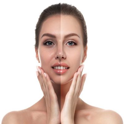 skin laser whitening skin laser whitening